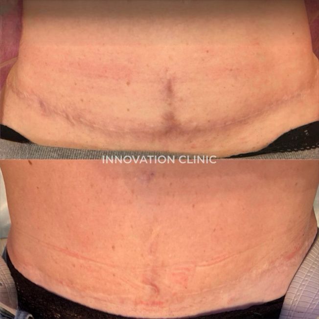 Лазерная шлифовка живота фото до и после