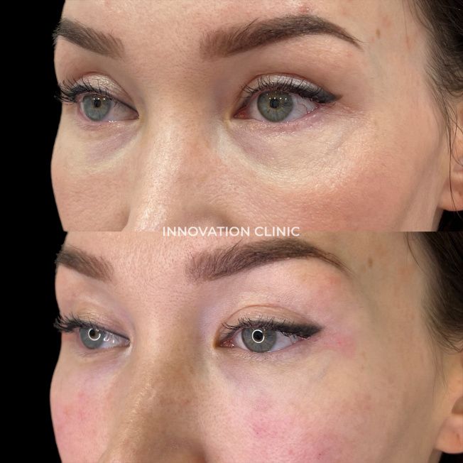 Коррекция носослёзной борозды фото до и после 2