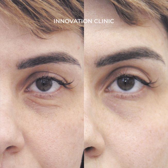 Коррекция носослёзной борозды фото до и после 7