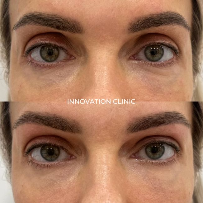 Коррекция формы верхнего века фото до и после