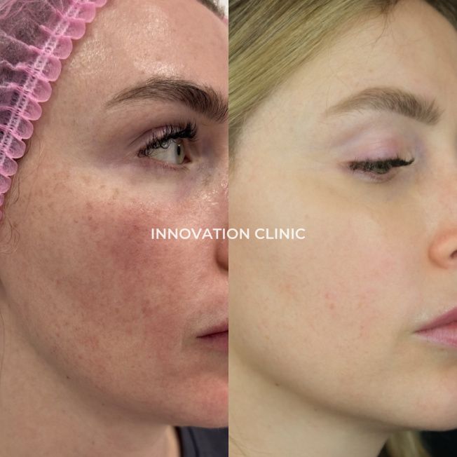 Лечение пигментации фото до и после 4