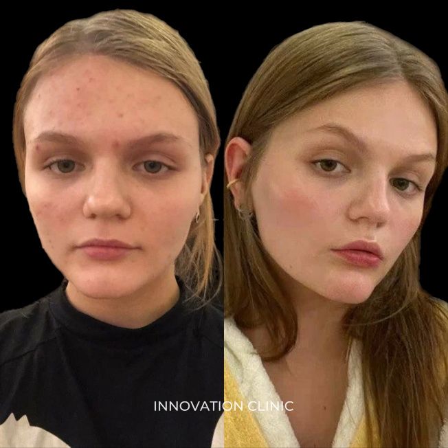 Комплексное лечение акне фото до и после 26