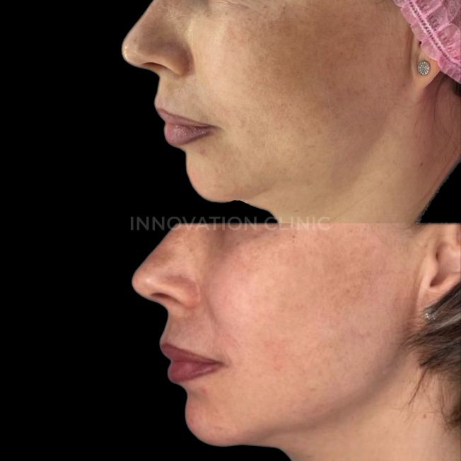 Коррекция нижней трети лица фото до и после 1