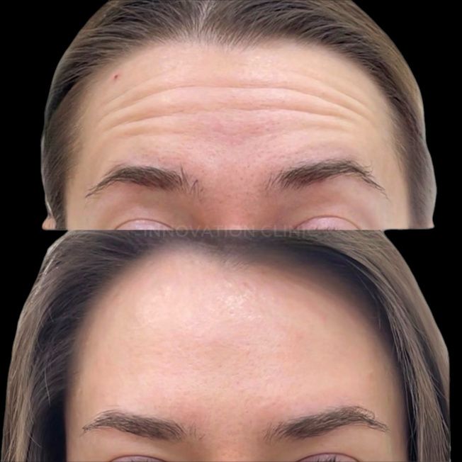 Коррекция мимических морщин лба фото до и после 4