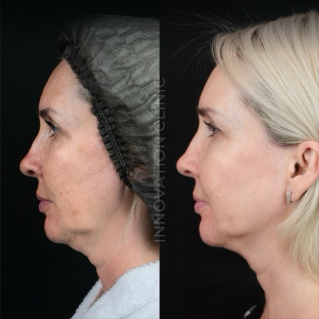 Монополярный RF-лифтинг Volnewmer фото до и после 6