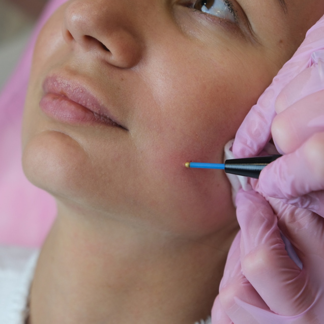 Удаление папиллом