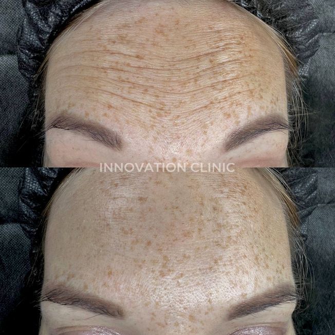 Коррекция мимических морщин лба фото до и после 2