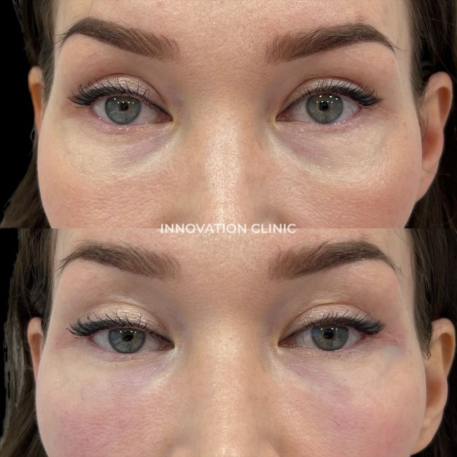 Коррекция носослёзной борозды фото до и после 1