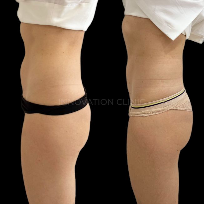 Радиочастотная липосакция фото до и после