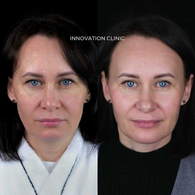 Протокол лечения пигментации фото до и после 