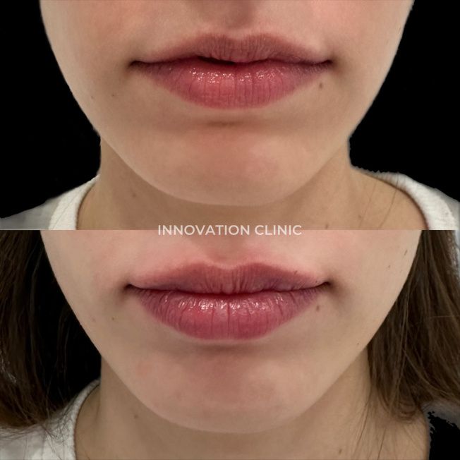 Коррекция формы губ филлером фото до и после 23