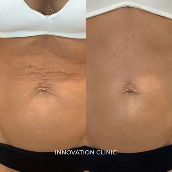 Микроигольчатый RF-лифтинг живота фото до и после 1