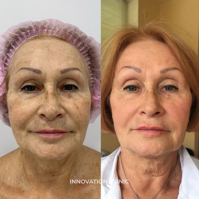 Лазерная шлифовка лица фото до и после 5