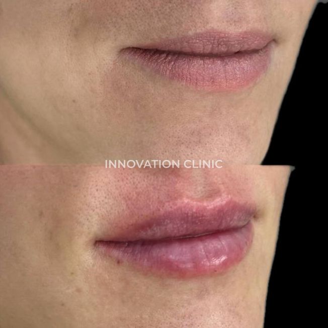 Коррекция формы губ филлером фото до и после 14