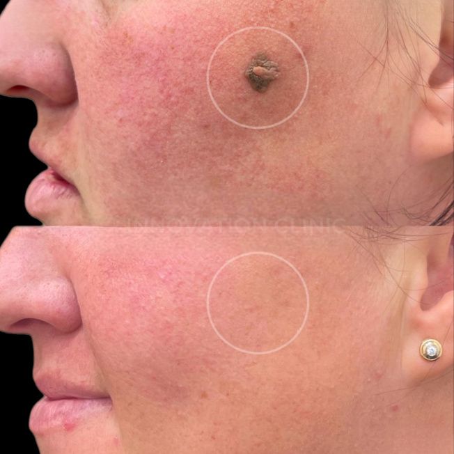 Удаление доброкачественного новообразования фото до и после 2