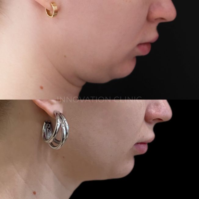 Малоинвазивный RF-лифтинг фото до и после 3