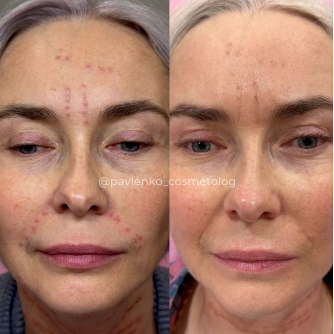 Лечение гранулемы инородного тела