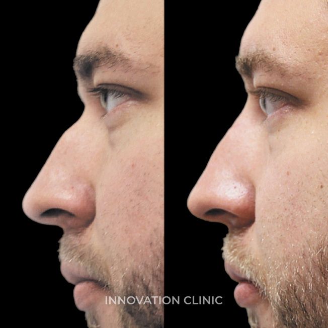 Коррекция спинки носа филлером фото до и после 1