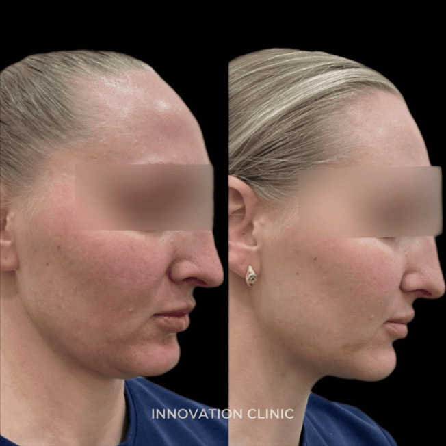 Устранение локальных жировых отложений фото до и после 1