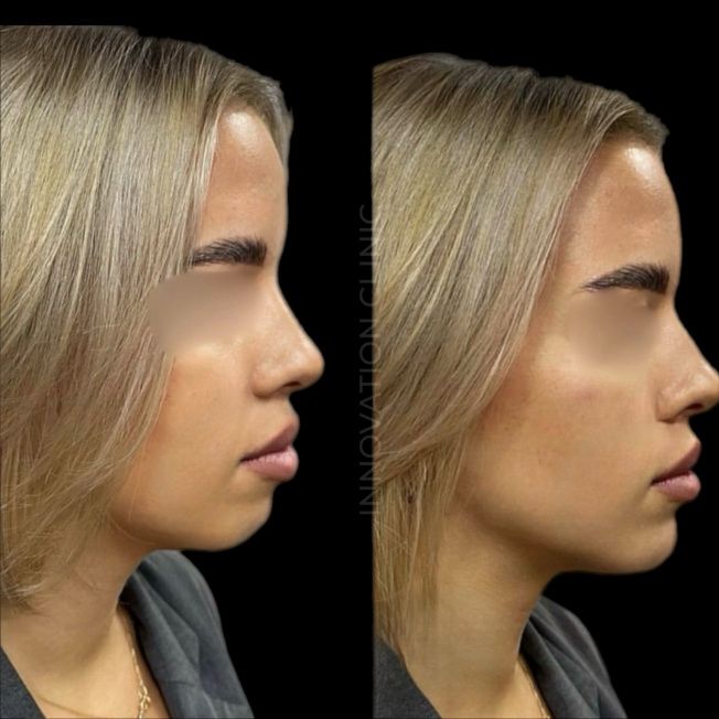 Коррекция подбородка филлером фото до и после 3