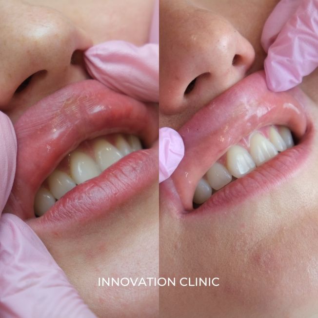 Удаление мигрировавшего филлера фото до и после 2