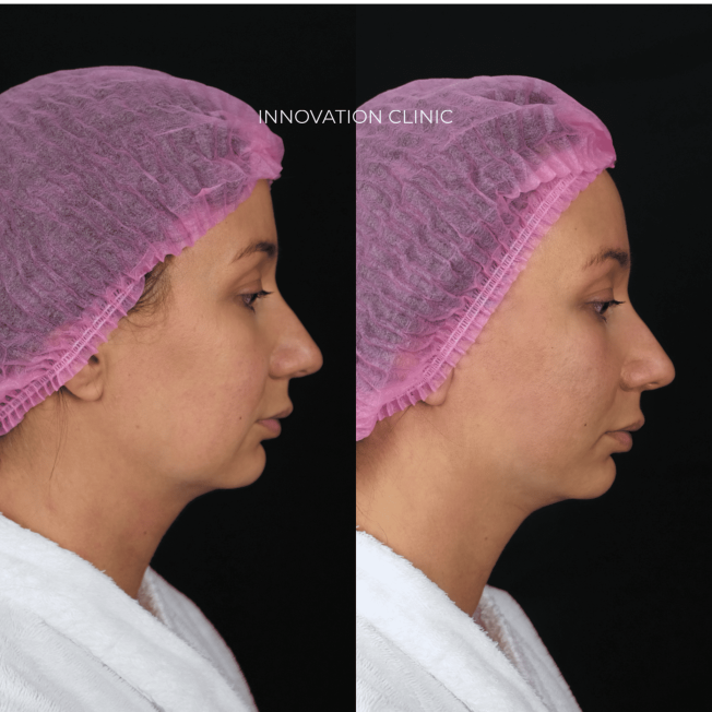 Лифтинг нижней трети лица нитями Aptos  