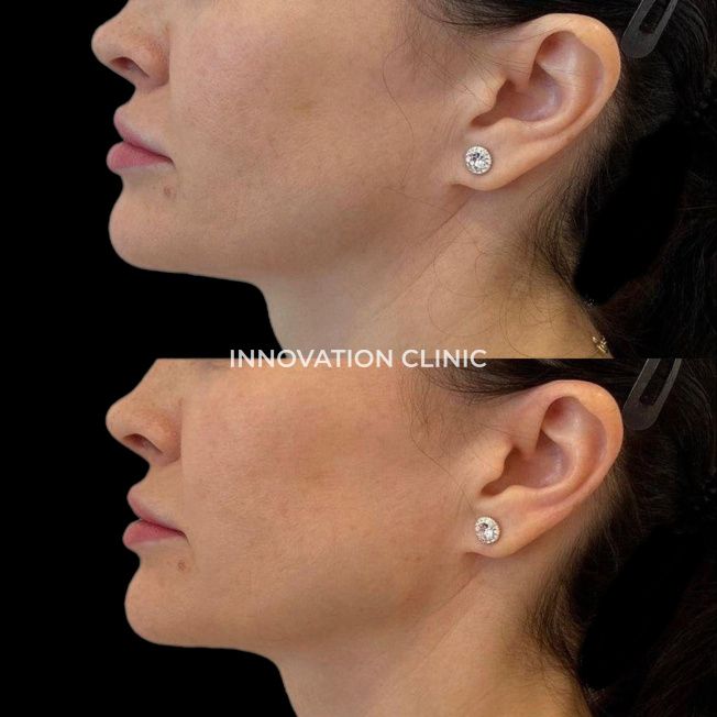 Коррекция нижней трети лица фото до и после 3