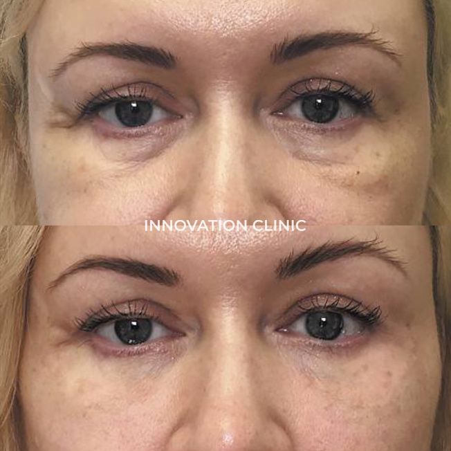 Коррекция носослёзной борозды фото до и после 5