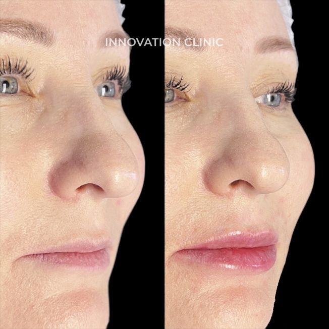 Коррекция формы губ филлером фото до и после 10