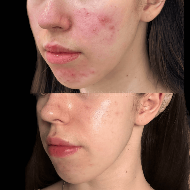 Комплексное лечение акне фото до и после 7
