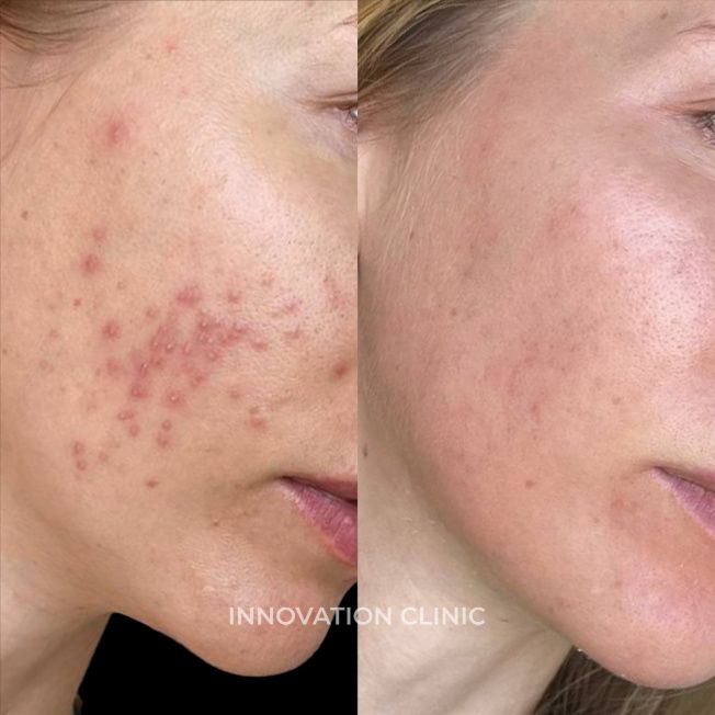 Комплексное лечение акне фото до и после 6