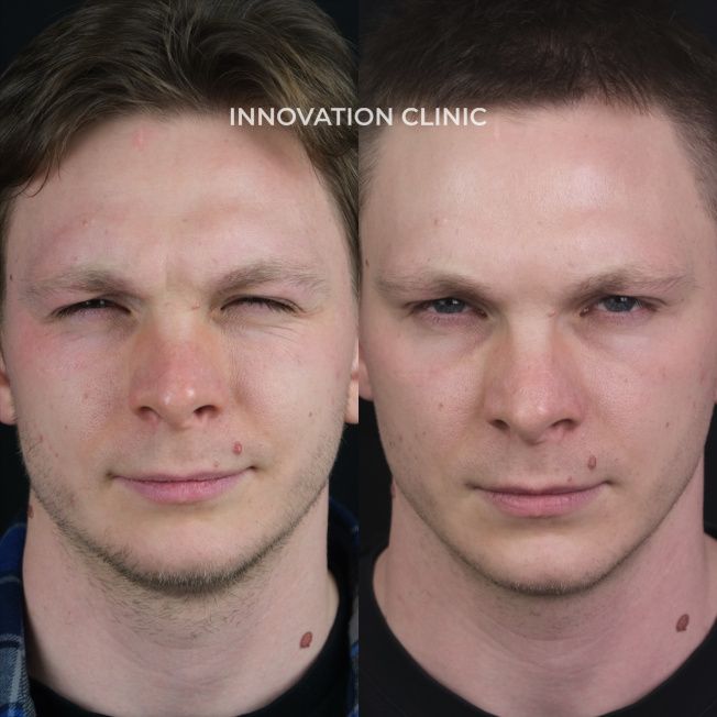 Коррекция мимических морщин лба фото до и после 9