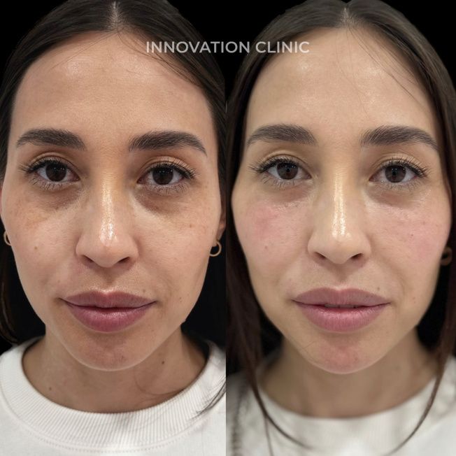 Коррекция носослёзной борозды фото до и после 4