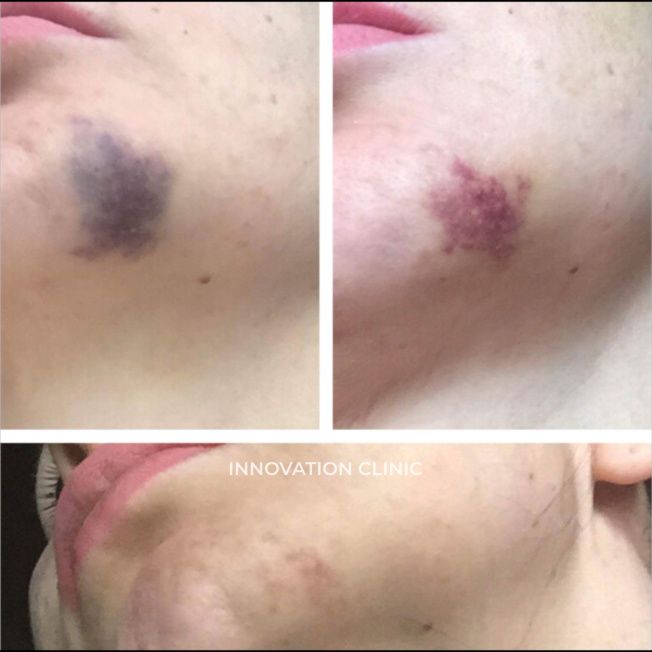 Ускорение схождения гематом фото до и после