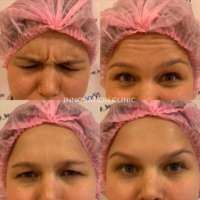 Коррекция мимических морщин лба фото до и после 3