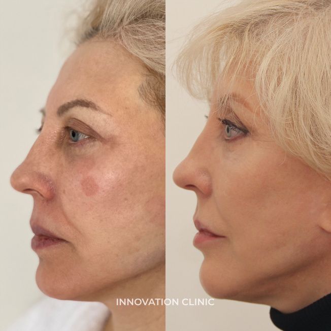 Лазерная шлифовка лица фото до и после 4