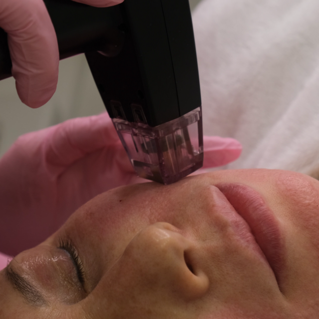 Игольчатый РФ-лифтинг