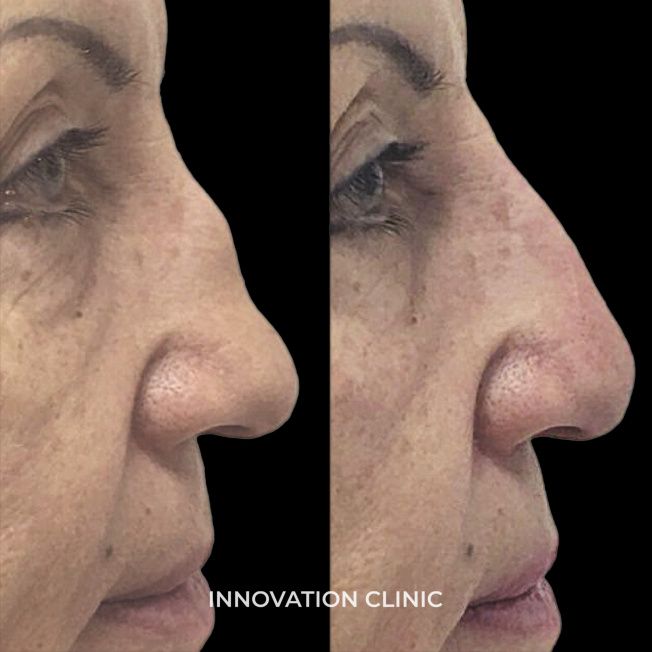 Коррекция спинки носа филлером фото до и после 2