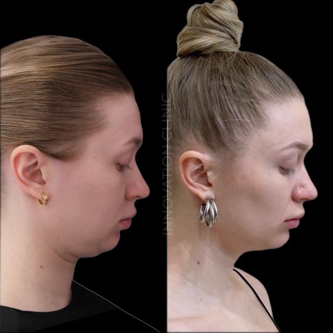 Малоинвазивный RF-лифтинг фото до и после 5