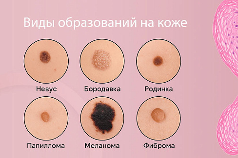 Показания к удалению папилломы