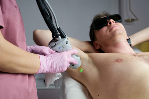 Процедура лазерной эпиляции Candela