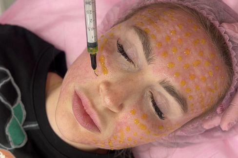 Очищение пор пилингом