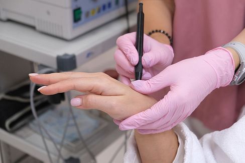 Молекулярно-резонансное удаление бородавки