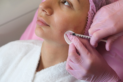 Процедура удаления папиллом лазером