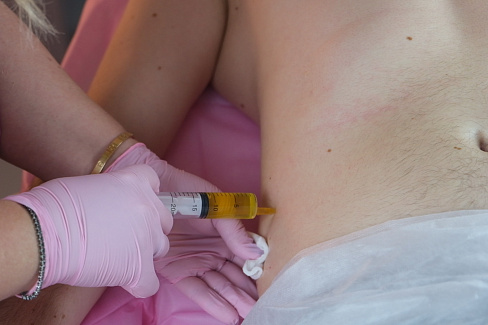 Мезотерапия для похудения избавит от целлюлита