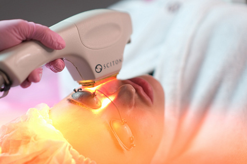 Лечение розацеа лазером не проводится при загаре