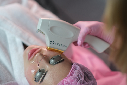 Фотоомоложение лица в летний период