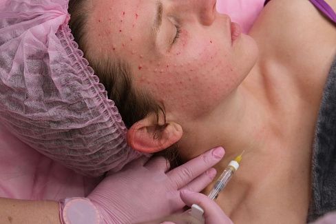 Процедура для лечения пигментации