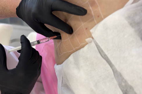 Мезотерапия для похудения в клинике INNOVATION