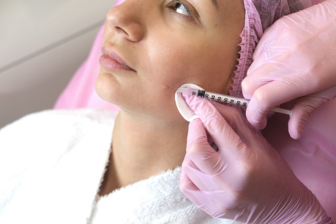 Удаление келоидных и гипертрофических рубцов